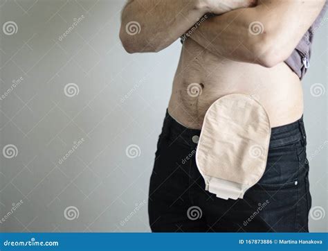 Colostomy Surgical Appliances Royalty Free Stock Image Cartoondealer