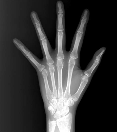 Imaging Of Marfan Syndrome Multisystemic Manifestations Radiographics