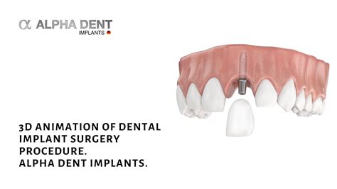 3d Animation Of Dental Implant Surgery Procedure Alpha Dent Implants