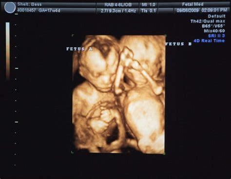 8 Week Ultrasound Hidden Twins