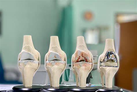 Total Knee Replacement Surgery Singapore Hip And Knee Orthopaedics