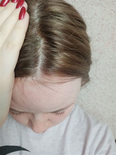 Аллергия на краску для волос Начал опухать лоб Вопрос аллергологу