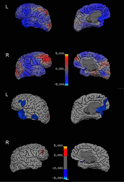 Cte Brain Mri Brain Images From Ubs Healthy Aging Mind Project