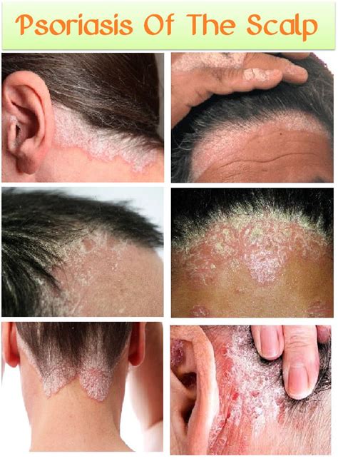 Scalp Psoriasis Of The Scalp Psoriasis Remedies Scalp Scalp