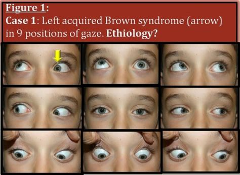Ocular Motility Binocular Vision Flashcards Quizlet