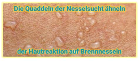 Und bisher seien keine fälle beobachtet worden, bei denen plötzlich andere schwere symptome aufgetreten seien. Nesselsucht beim Baby: So linderst du den Juckreiz bei ...