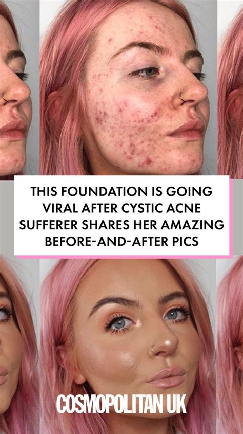 This Foundation Is Going Viral After Cystic Acne Sufferer Shares Her