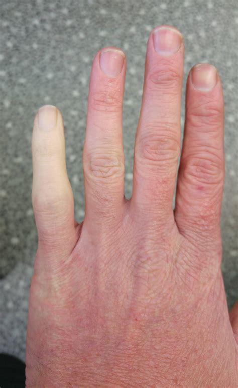 Photo Of Finger Turning White In The Cold Goes Viral Photos