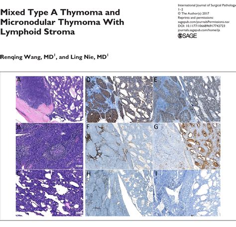 Figure 1 From Mixed Type A Thymoma And Micronodular Thymoma With