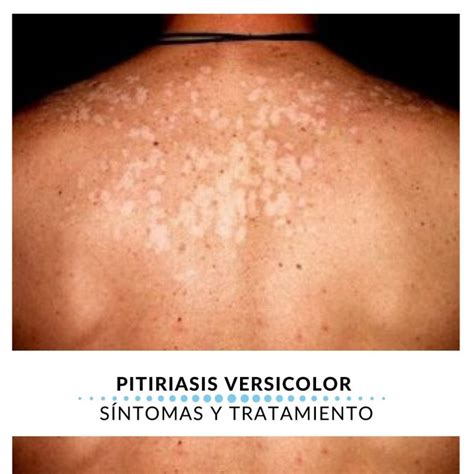 Pitiriasis versicolor Síntomas y tratamiento