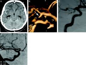 Multi Section Ct Angiography For Detection Of Cerebral Aneurysms