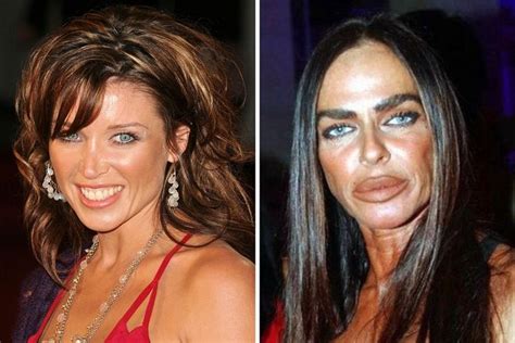 Botched Plastic Surgery Bad Plastic Surgeries Celebrities Then And