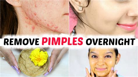 How To Remove Pimples Overnight Acne Treatment Anaysa Youtube
