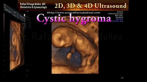 2d And 4d Ultrasound Genetic Cystic Hygroma Clinica Ginecologica Dr
