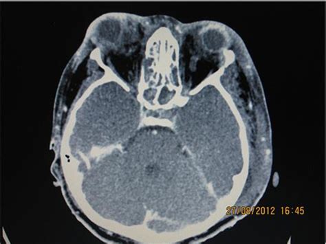 Bilateral Traumatic Globe Luxation With Optic Nerve Transection