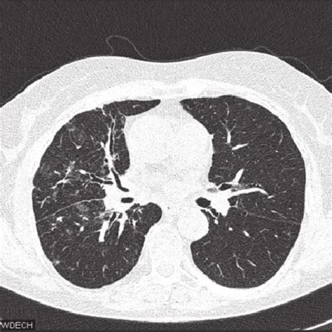 Ct Scan December 2005 — Marked Regression Of Pulmonary Consolidations
