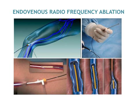 Endovenous Thermal Ablation Treatment In Mumbai Dr Avinash Katara