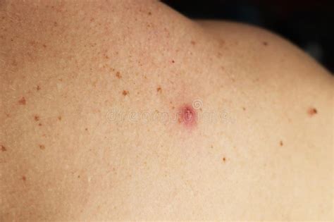 Photo Of A Pimple With Pus On The Back Of A Man Stock Photo Image Of