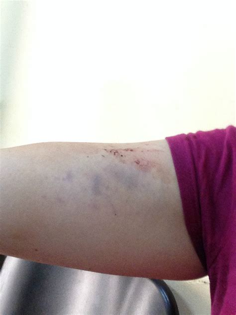 Bruise On Upper Arm