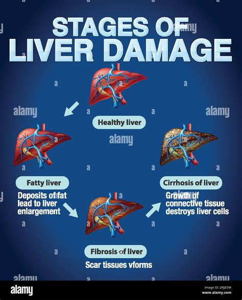 Stages Of Liver Damage Infographic Illustration Stock Vector Image