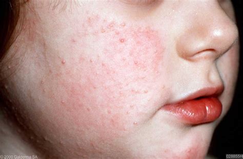 Folliculitis is a common skin condition in which hair follicles become inflamed. What is Keratosis Pilaris on the Face | Dorothee Padraig ...