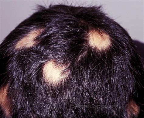 Characterisation of inflammatory infiltrates in male pattern alopecia: Alopecia Areata - Treatment, Causes, Symptoms, Pictures