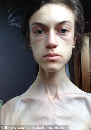 Anorexic Says Instagram Recovery Accounts Saved Her Daily Mail Online