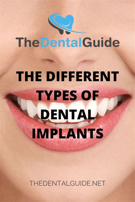 The Different Types Of Dental Implants The Dental Guide