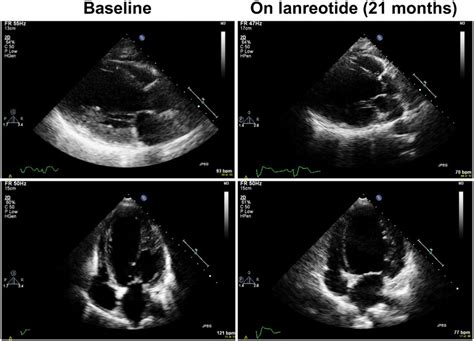 Echocardiographic Features Of Dilated Cardiomyopathy Before And After