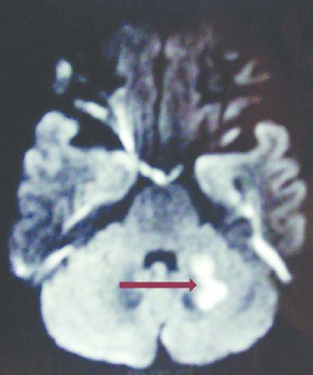 Dwi Image Showing Restricted Diffusion In Left Cerebellar Hemisphere