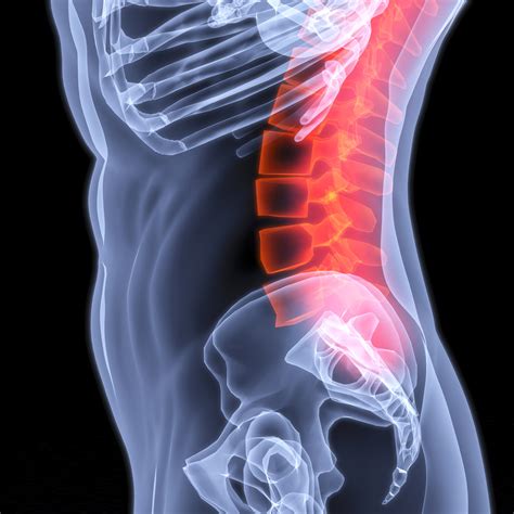 Sib 445 Pain And Lumbar Spine Osteoarthritis — Matlin