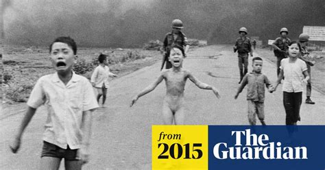 Vietnam Wars Napalm Girl Kim Phuc Has Laser Treatment To Heal Wounds