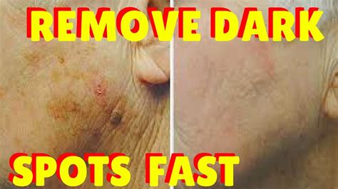 Liver Spots And Age Spots How To Remove Dark Spots On Face And Skin