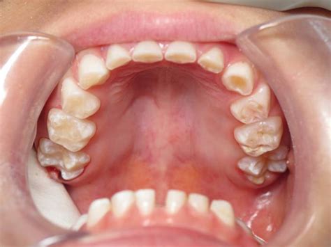 Teeth Grinding Orthodontist Pediatric Dentist Livermore Ca