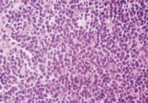 Mantle Cell Lymphoma Blastoid Cell Variant Hx And E X 200