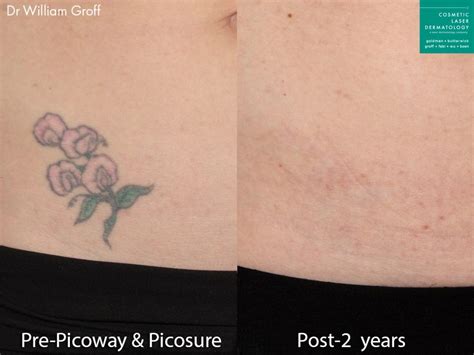 Picosure Tattoo Removal San Diego Ca Cosmetic Laser Dermatology