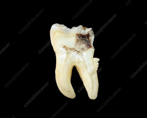 Decayed Tooth Structure Stock Image C0292236 Science Photo Library