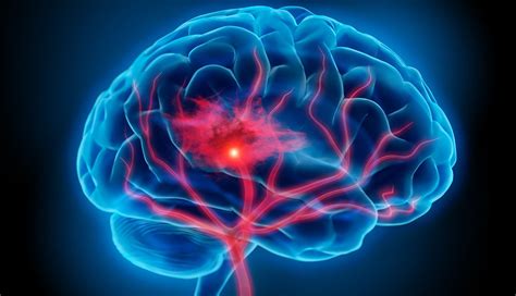 Brain Ischemia Causes Symptoms And Treatment Wellnessbeam