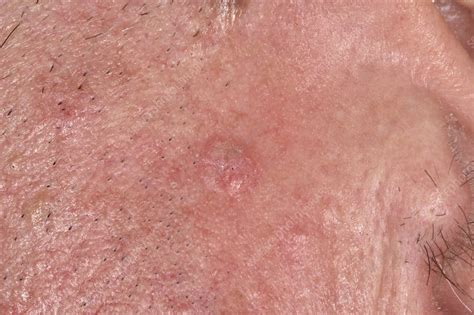 Bowenoid Keratosis Stock Image C0472858 Science Photo Library