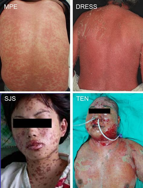 Severe cutaneous adverse drug reactions - Chung - 2016 - The Journal of ...