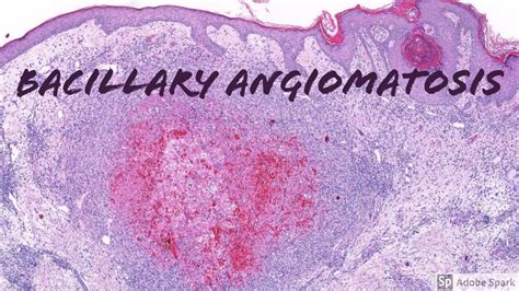 Bacillary Angiomatosis Dermatopathology Pearls Youtube