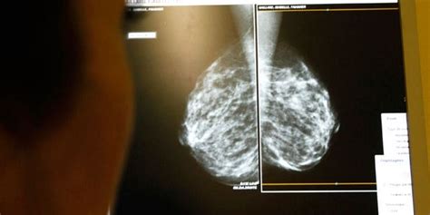 Estrogen Only Hormone Replacement Therapy May Reduce Breast Cancer Risk