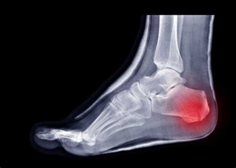 Calcaneal Fracture Broken Heel Bone Plantar Fasciitis Orthopedic