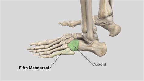 Fifth Metatarsal Jones Fractures Review And Surgical Technique For Intramedullary Screw