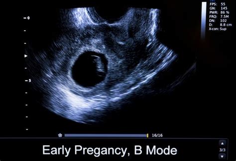 Your nhs with everyone is a dating scan. How accurate are dating scans at 9 weeks | How accurate is ...