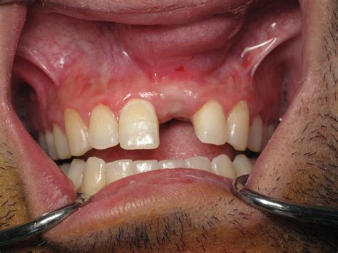 Block Bone Graft For Dental Implants 2015 Update Ramsey Amin Dds