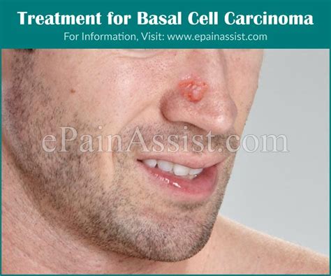 What Is Basal Cell Carcinoma And How Can It Be Treated