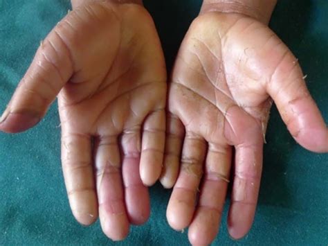 Acral Peeling Skin Syndrome Definition Symptoms And Treatment