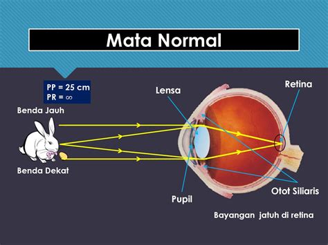 Skema Rel Presisi Untuk Mata Normal Hipermentropi Dan Miopi