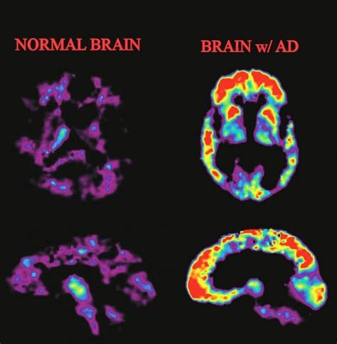 17 Best Images About Pet Scan On Pinterest Alzheimers Depression And
